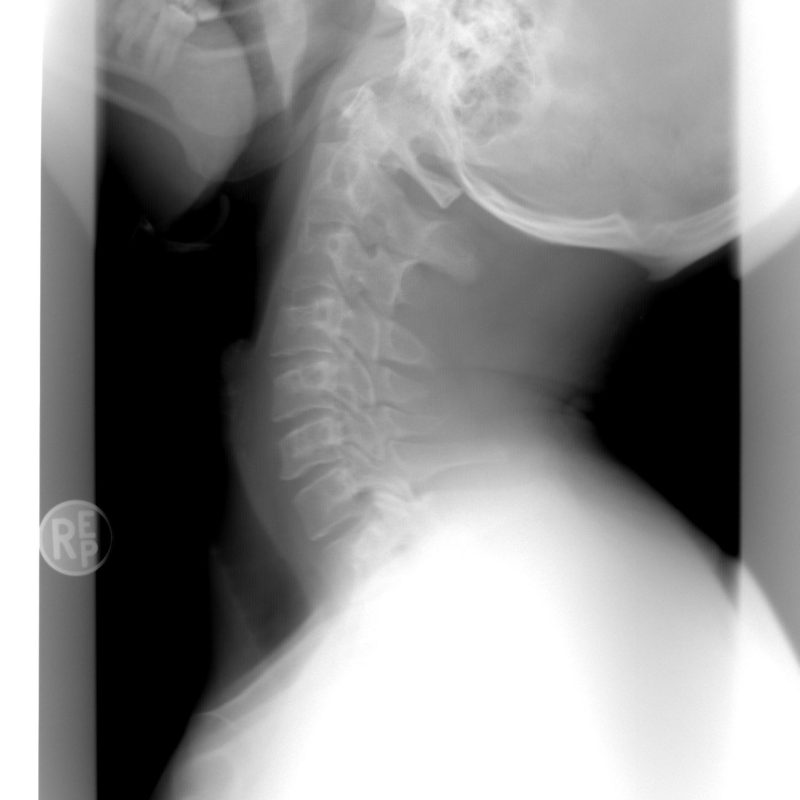Xray picture for upper cervical san antonio tx